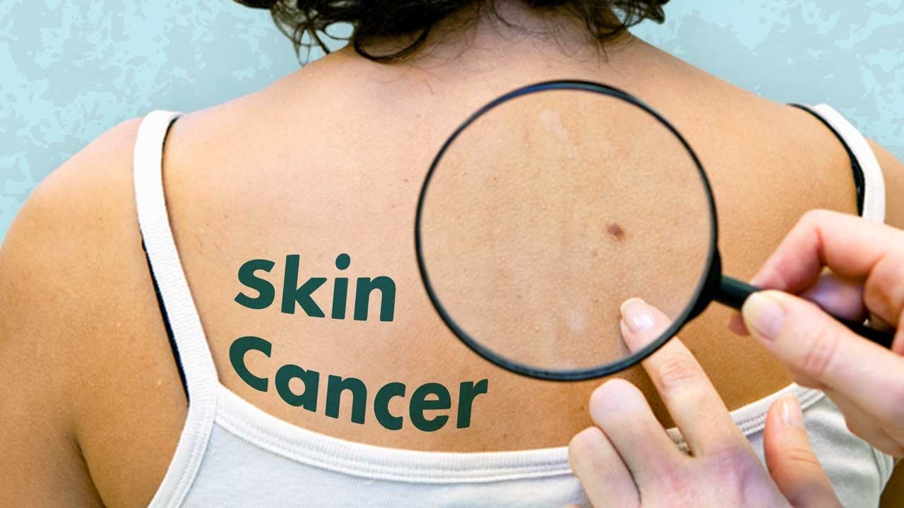 skin cancer symptoms: Causes and Treatment